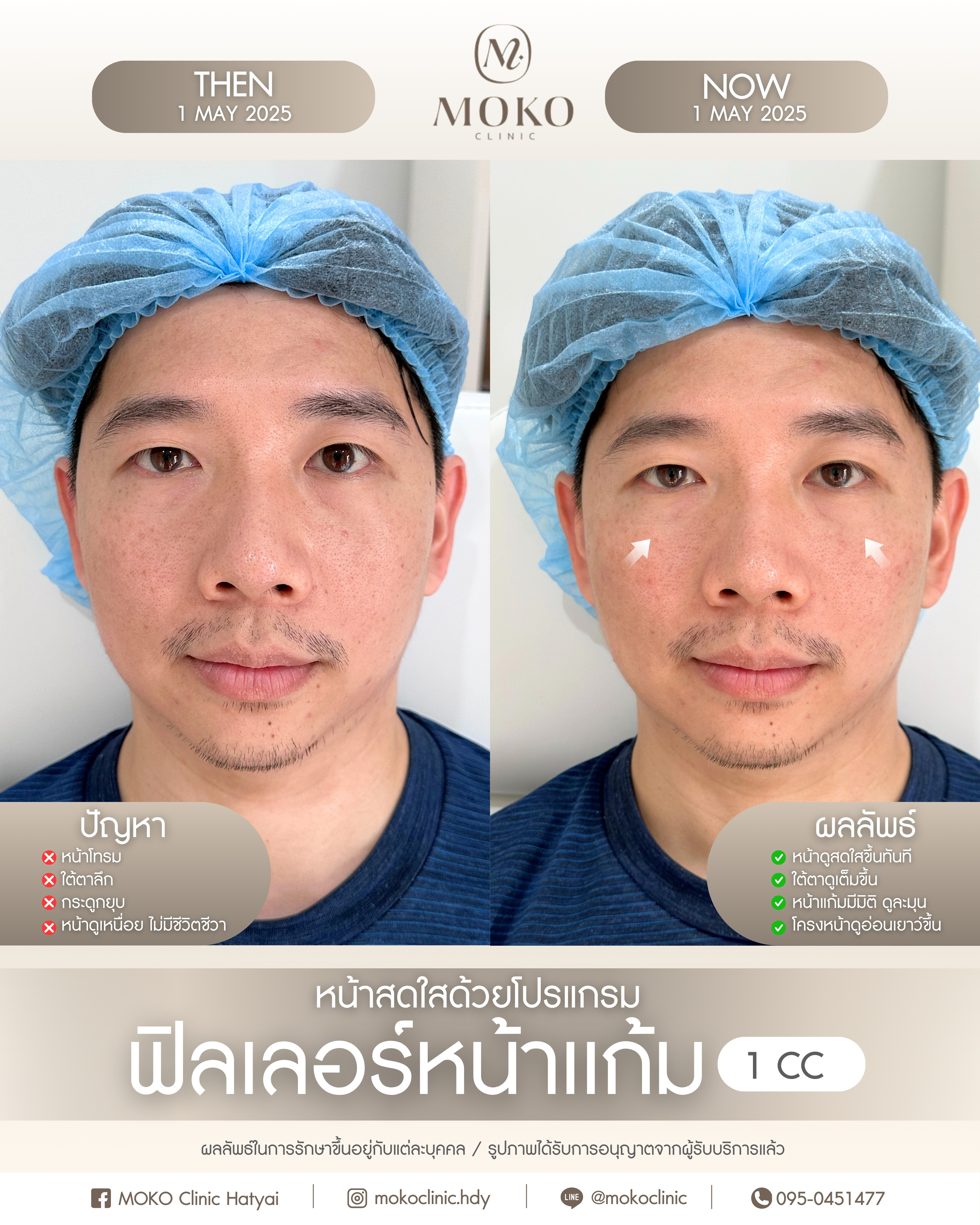 Before After Results 6